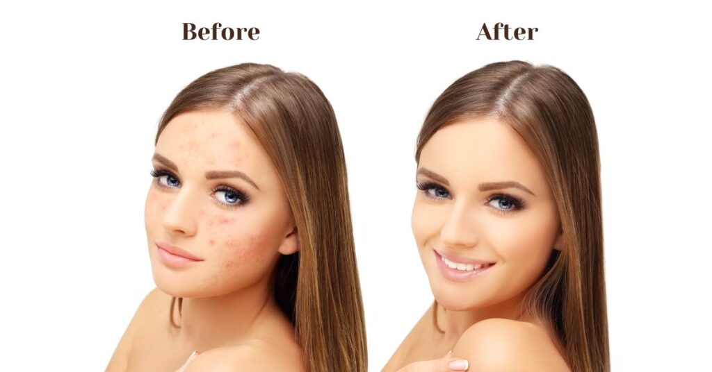 Esteriñ before and after use